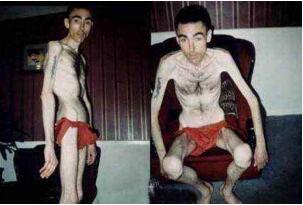 世界上最瘦的男人，费瑞尔·季利兹(患厌食症仅重80斤)