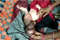 印度女子产下拥有三个头婴儿：共用一个身体