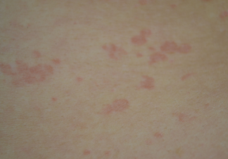 什么季节容易长湿疹 做好哪些事能有效预防湿疹