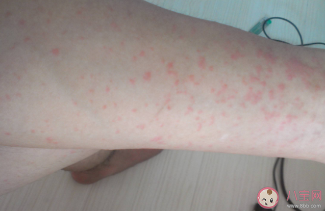 长湿疹是不是要少洗澡 得了湿疹生活中应该注意什么