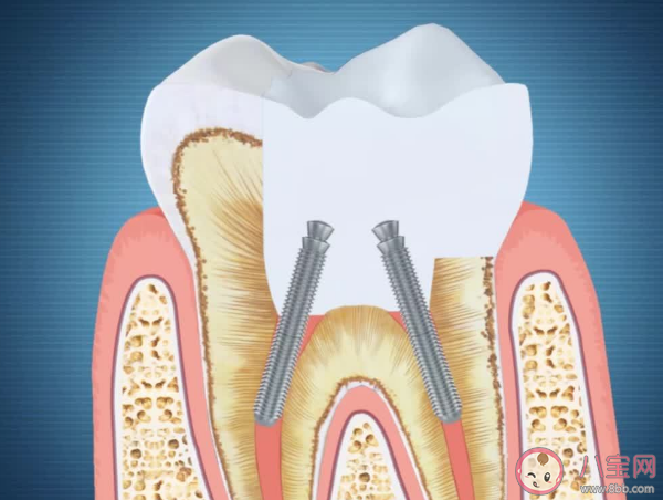 杀死牙神经后牙还能活多久 根管治疗有什么好处