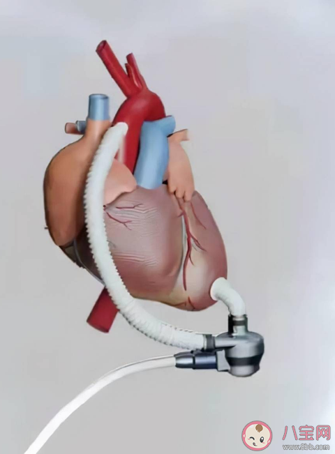 全国首例心脏不停跳人工心脏植入 突破性技术对心脏疾病有何意义
